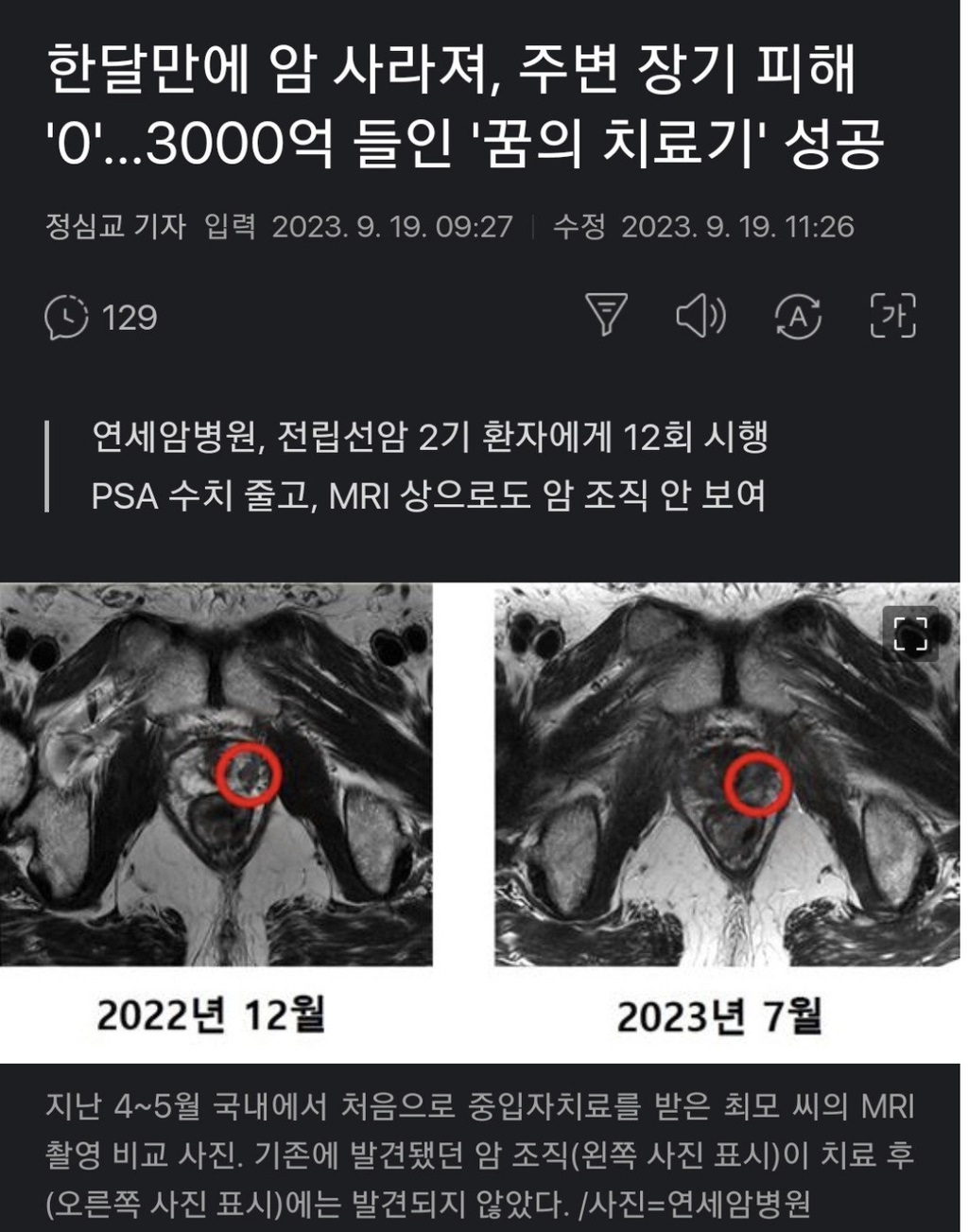 연세대 세브란스 병원 암치료 근황